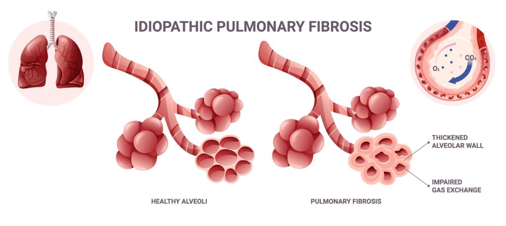 “Diagram showing Pirfenidone inhibition of fibrotic signaling pathways”