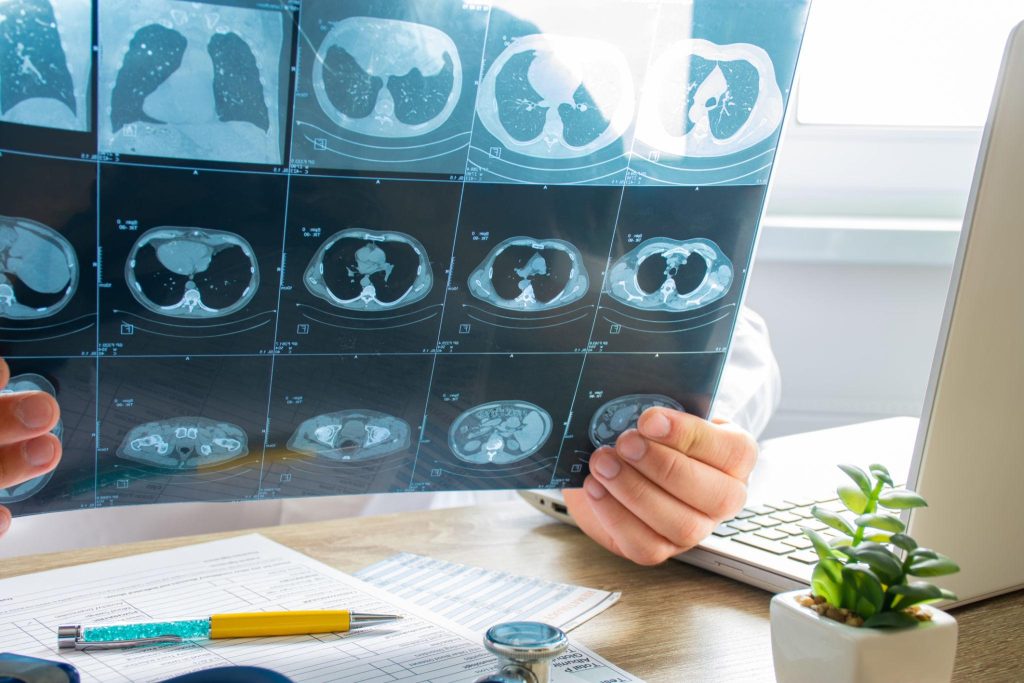 “Pulmonologist evaluating CT imaging for idiopathic pulmonary fibrosis”